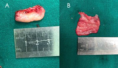 Intradural fat graft packing is not indispensable in preventing postoperative cerebrospinal fluid leakage in endoscopic endonasal pituitary adenoma surgeries